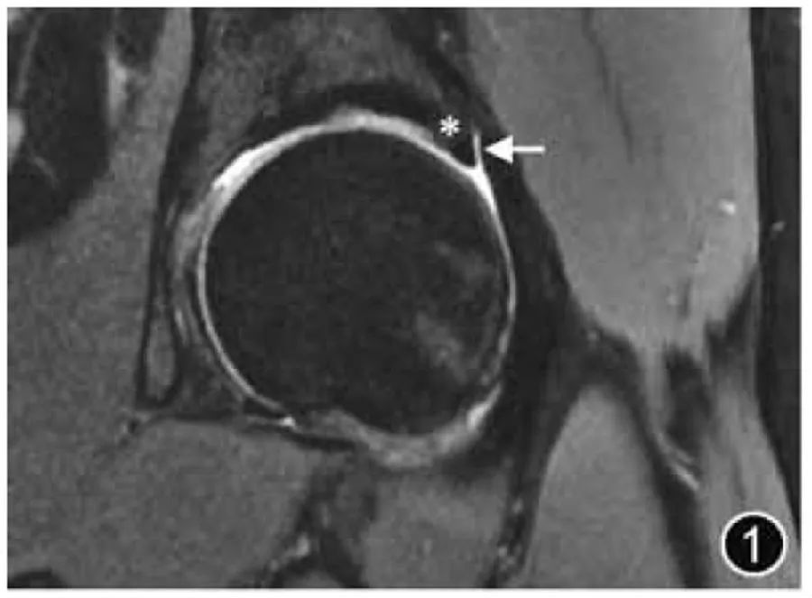 Do you understand these key points of MRI diagnosis of hip joint lesions?