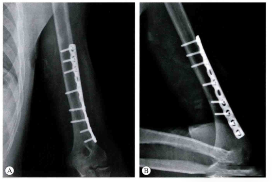 The Magical Effect of Proximal Humeral Plate in Minimally Invasive Treatment of Distal Humeral Shaft Fractures
