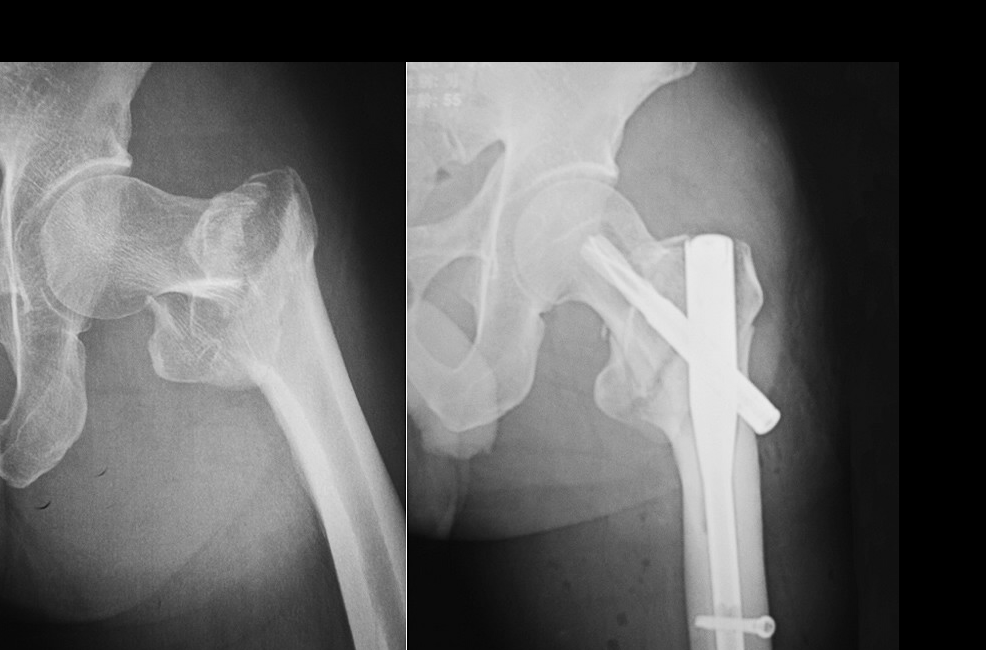 Surgical Techniques for Closed Reduction and PFNA Internal Fixation in the Treatment of Intertrochanteric Fractures of the Femur